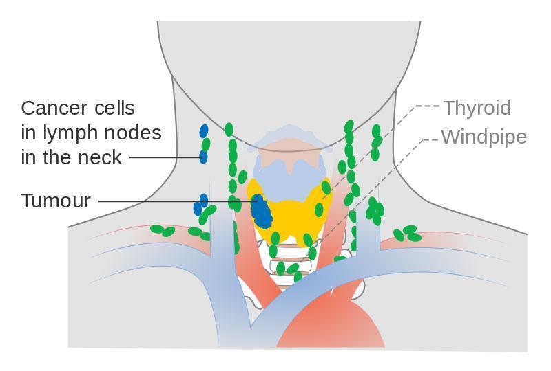 甲状腺やそれにリンパ節に広がる癌細胞や腫瘍の概念図　©Cancer Reserach UK